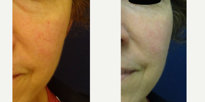 35-44 year old woman treated with Laser Hair Removal, Nonsurgical Facelift, Nonsurgical Neck Lift, Chemical Peel - 38 year old before and 3 years after 5 no downtime laser treatments with Fotofacial and a nonsurgical facelift (skin tightening). She was bothered by a few pigmented lesions, veins and rosacea. Patient was not interested in surgery.