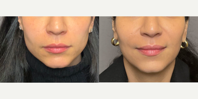 35-44 year old woman treated with Dysport, Botox, Xeomin - Neurotoxins on Masseters.