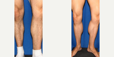 Man treated with Calf Implant - Man treated with Calf Implant