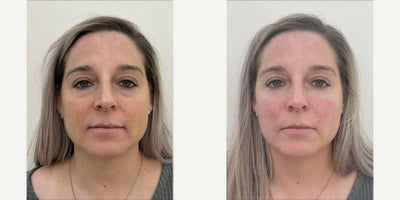 45-54 year old woman treated with Restylane, Dermal Fillers, Cheek Lift - Under eye filler.