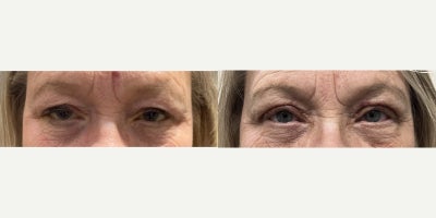 55-64 year old woman treated with Ptosis Repair - Ptosis Repair