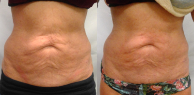 65-74 year old woman treated with BodyFX - Patient after 1 treatment