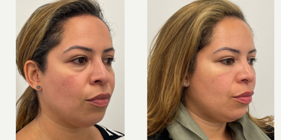 35-44 year old woman treated with Belotero, Voluma - Voluma to cheeks and Belotero to under eye.