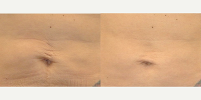 57 year old woman treated with Skintyte - This 57 year old female received 5 laser skin tightening sessions and enjoyed improvement in the wrinkles on her belly.