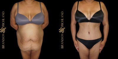 35-44 year old woman treated with Tummy Tuck, Liposuction, Renuvion - Tummy Tuck, Liposuction, and Renuvion for a beautifully sculpted figure! Our patient, in her 40s, is overjoyed with the toned, contoured results, achieving a flatter abdomen and smoother skin. She feels more confident and empowered with her new shape!