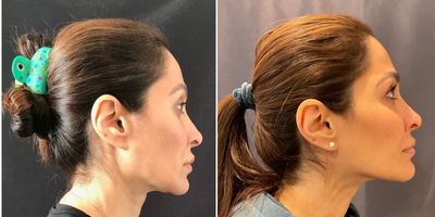 45-54 year old woman treated with Emface - Emface non surgical face and neck lift