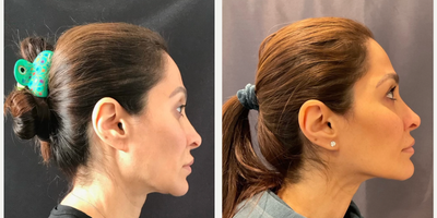45-54 year old woman treated with Emface - Emface non surgical face and neck lift