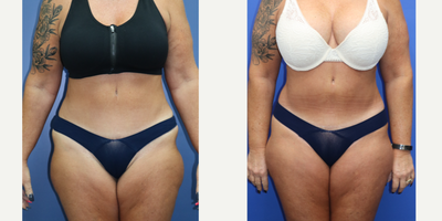 49 yo Woman had liposuction of the abdomen and fat transfer to the breast - 49 year old woman who had previously had a breast lift with implant exchange and tummy tuck 7 months prior, underwent liposuction of the anterior *(front) abdomen and fat transfer to the breast to soften the appearance of her breasts and to further even out her natural differences from side to side.
