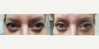 45-54 year old woman treated with Botox and Plasma Pen - This patient received a botox brow lift as well as plasma pen skin tightening on the upper eyelids for a non-surgical eyelid lift