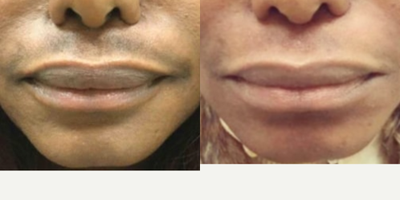45-54 year old woman treated with Skin Lightening - Patient received skin brightening & lightening treatment on the upper lip using Dr. Ariel Ostad's Luma Peel treatment.