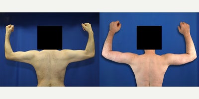 Comprehensive Post Weight Loss Surgery for a Remarkable Total Body Reset - This transformation required a comprehensive post-weight-loss surgery plan because one procedure alone would not have addressed the full extent of our patients excess skin. Our patient is a 32-year-old White male who came to Dr. J. Timothy Katzen after an extraordinary weight loss journey. He had previously been morbidly obese, with a maximum weight of 440 pounds, and through diet and exercise, he lowered his weight to 154 pounds. Although this was a life-changing accomplishment, he was left with significant loose skin throughout multiple areas of the body. Under general anesthesia, Dr. Katzen created a body transformation plan that included a circumferential body lift, brachioplasty, medial thigh lift, and torsoplasty with vertical incisions along the sides of the body. A circumferential body lift removes excess skin around the abdomen, waist, hips, and lower back to create a smoother lower body contour. Brachioplasty, also known as an arm lift, removes excess skin from the upper arm. A medial thigh lift targets loose skin along the inner thigh, resulting in a tighter, more refined leg shape. Torsoplasty with vertical side incisions helps remove excess skin and flab from the side of the chest, improving the chest contour after massive weight loss. Together, these post-bariatric body contouring procedures helped reshape multiple problem areas that exercise alone could not fix. These photos were taken 1 year after surgery and show our patients remarkable results. His body now reflects the discipline, sacrifice, and determination that made his weight loss possible.