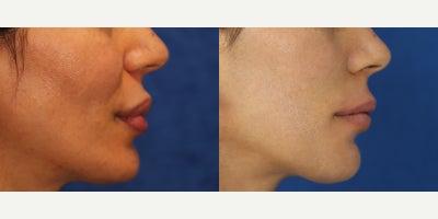 Foreign Body Lip Injection Removal After Illegal Permanent Filler Injections - Permanent lip fillers can become a serious problem when they cause pain, burning, and changes in the way the lips look and feel. Our patient is a 41-year-old White female who sought Dr. J. Timothy Katzen after having permanent filler placed illegally into both the upper and lower lips 20 years ago by an aesthetician in Germany. She had been told the product was a biopolymer. Years later, she began experiencing burning sensations in her lips and wanted the product removed before the problem worsened. Dr. Katzen recommended lip foreign-body injection removal to remove the permanent filler and the tissue affected by it. Under general anesthesia, he carefully opened the lips and removed the abnormal material from both the upper and lower lips. Lip foreign body removal is often needed when permanent fillers harden, irritate the tissue, or create an unnatural contour. Unlike temporary fillers, permanent products can remain in the lips for years and continue causing symptoms. The goal of surgery is to remove the foreign material, improve comfort, and help restore a more natural lip shape. These photos were taken 1 week after surgery and already show our patients remarkable result. Her case demonstrates Dr. Katzens expertise in lip filler removal surgery, permanent filler removal, and foreign body removal of the lips for symptomatic biopolymer injections. Early healing already suggests a softer texture, better contour, and improved comfort.