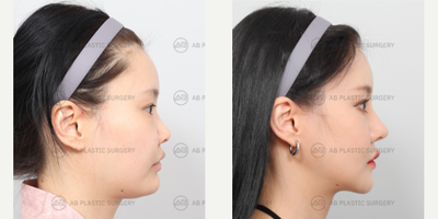 25-34 year old woman treated with Genioplasty, Jaw Reduction, V Line Surgery, Rhinoplasty, Cheekbone Reduction - Mandible Jaw Reduction, Genioplasty, Zygoma Reduction, Rhinoplasty (Nose Ridge+Nose Tip+Short Nose Correction+Weir Reduction+Donated Rib Cartilage (use at nose tip))