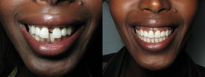 Invisalign for Severe Spaces - Invisalign treatment for 16 months to correct large gap between front teeth.