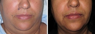 Mole Removal photos - 
	Mole Removal photos
