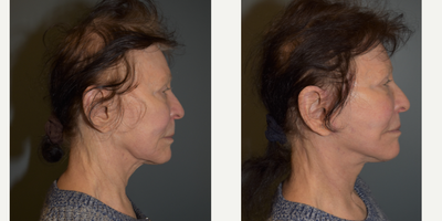 75 and up year old woman treated with Facelift, Lip Lift, Lower Facelift, Neck Lift, CO2 Laser, ActiveFX - This woman is 76 years old, 5'2 and 125 pounds. She presented requesting lower face and neck lift. She also had a sub-nasal lip lift and CO2 laser resurfacing of her central face.