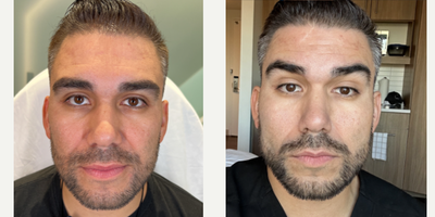 SIMPLY SENSATIONAL THREADS - Our patient is the face of a YouTube channel that has a million subscribers, so he only trusts the best with his face. While he already has great facial features, we will be contouring and sculpting his face with Miracu PDO threads for an enhanced, rejuvenated look. We used the threads in his mid face and lower face, crossing the two zones to maximize his results. He is blown away by how amazing his final results are!