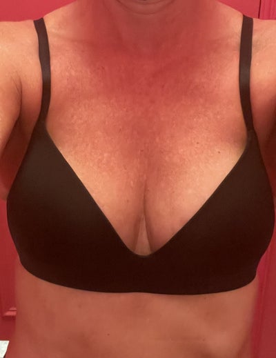 Explant, Lipo and Fat Transfer to Breast - Review - RealSelf