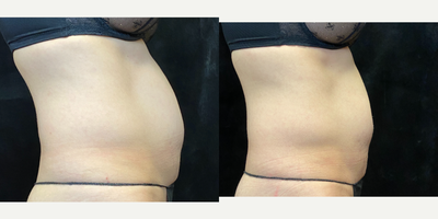 35-44 year old woman treated with SculpSure, Evolve - Non invasive fat reduction with combination therapy Sculpsure and Evolve Tite. Sulpsure is a safe, non-invasive laser body contouring treatment that helps you achieve a slimmer, more natural-looking appearance. No surgery. No downtime. Just results. Each treatment area is complete in 25 minutes to permanently reduce stubborn fat without surgery or downtime. SculpSure is the worlds first FDA-cleared laser device for non-invasive lipolysis of the abdomen, flanks, back, inner thighs, outer thighs and submental area. Evolve Tite leverages clinically proven and safe, radio-frequency technology to stimulate collagen production and provide the ultimate in customizable body reshaping. It can reduce unwanted fat and tighten skin comfortably. As the radio-frequency penetrates the dermal layers patients will notice a reduction in the folds of their skin leading to a smoother contour of the body. Textural irregularities will even out and sagging skin will appear more toned. When these two treatments are combined, we have beautiful results. Sculpsure is done once a month (for 2 treatments) and Evolve Tite is done weekly in between.
