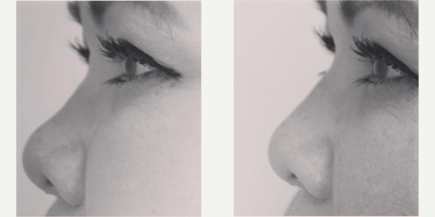 Woman treated with Rhinoplasty - Woman treated with Rhinoplasty