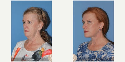 62 year old woman treated with Deep Plane Facelift, Neck Lift, Botox, MACS Facelift - 62 year old woman treated with Deep Plane Face and Neck Lift, Fat Grafting to Cheeks, Botox, MAC