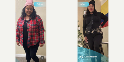 25-34 year old woman treated with Gastric Bypass - I am proud of you!!! This is what hard work and dedication looks like.Gastric Sleeve surgery has been shown to improve many obesity-related health conditions such as: type 2 diabetes, high blood presure, high cholesterol, sleep apnea, joint pain, and heart disease.