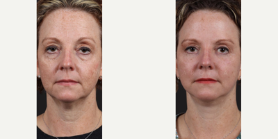 Woman treated with Eyelid Surgery - Natural facial rejuvenation. It was a pleasure to see this lovely patient 6 months after her upper and lower blepharoplasty, mini facelift, fat injections and laser. She is also a busy doctor. I frequently perform surgery on doctors, nurses and others in health care - we have the unfortunate reputation for being the the worst patients. In her case, nothing could be further from the truth. She is such a kind, funny, and easy going person. It was a pleasure caring for her and I am grateful she entrusted me with her face.