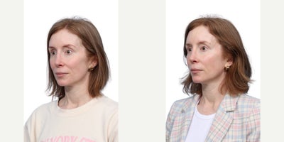 Woman treated with Ultralase, Vbeam - Woman treated with Ultralase, Vbeam