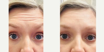 35-44 year old woman treated with Daxxify - Daxxify Injected to her Crows Feet, Glabella & Forehead