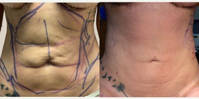 45-54 year old woman treated with Renuvion, Laser Liposuction, Vaser Liposuction - This client came to us unhappy with liposuction done at another practice. Dr. Song used Power Assisted Liposuction and Renuvion Skin Tightening to smooth out & tighten the abdomen.