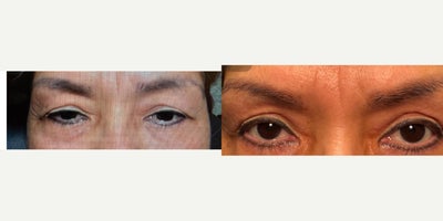 45-54 year old woman treated with Ptosis Surgery and browpexy - 45-54 year old woman treated with Ptosis Surgery and browpexy