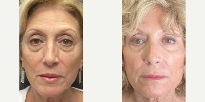 55-64 year old woman treated with Secret RF, Xeomin, Microneedling, Cheek Fillers, Lip Fillers, Lip Threading - Full Facial Rejuvination with Secret RF microneedling, 8-pt lift with Restylane and Versa +, and PDO threads in lip borders.