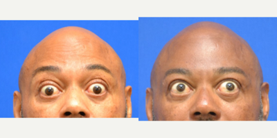 55-64 year old man treated with Daxxify - Improved forehead and frown linesInjected by Scarlet PA-C