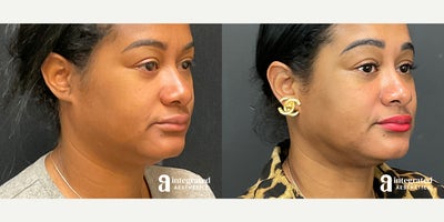 35-44 year old woman treated with AccuTite - The patient is a 36 year-old female who had aesthetic concerns with her submental/jowl region of the face. Dr. Cho performed Accutite to the lower face/neck and MyEllevate. The after results are 2 months post procedure.