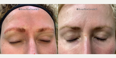 35-44 year old woman treated with PicoSure, Tattoo Removal - Patient wasnt happy with the color of her eyebrow tattoo due to her sparse eyebrow hairs, so the result shows mostly her natural hair growth. She can either use an eyebrow pencil, leave them as they are, or get them re-tattooed in a different color.2nd pair of photos - Previously,  tattooist used different metals in her dark brown tattoo, so when we applied the first laser treatment with a 1064nm wavelength to reduce the dark brown, it revealed red and yellow tones from the enhancers. The advantage of seeing a laser specialist is having access to multiple lasers and wavelengths, allowing us to use a different wavelength to target the red and yellow colors, which many practices cant do. In the second treatment, we effectively removed the red-brown color using a PicoPlus 532nm wavelength.