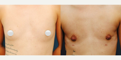 Woman treated with Masculinizing Top Surgery - Only 3 months post op and check out this Top Surgery result done through Keyhole incision. Keyhole is done via semi-circular incision at the base of the areola  this is where the breast tissue is removed through. Keyhole candidates typically have small breasts with minimal excess skin and good skin elasticity.