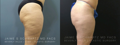 35-44 year old woman treated with Cellfina - Woman treated with Cellfina to get rid of cellulite.