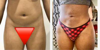 18-24 year old woman treated with Liposuction, BodyTite - 18-24 year old woman treated with Liposuction, BodyTite