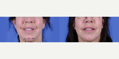 Woman treated with Lip Reduction - This wonderful patient had a V to Y upper lip advancement elsewhere and was left with redundant red lip tissue that was aesthetically and functionally problematic. We corrected the upper lip with a calculated lip reduction to restore lower face harmony. It all increased her upper tooth show.