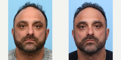 45-54 year old man treated with FUE Hair Transplant, Hair Transplant, Hair Loss Treatment, PRP for Hair Loss - This 46-year-old patient wanted to restore his hairline and add overall density. Dr. Wise performed an FUE hair transplant, placing 3,020 grafts on zones 1 and 2 of the patient's scalp. Additionally, he performed a session of PRP to fortify the follicles and expedite the healing process.