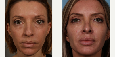 45-54 year old woman treated with Sculptra Aesthetic - Before age 44After age 49It was so nice to see our lovely patient today for her annual Sculptra maintenance treatment.  When she first presented to us 5 years ago at age 44, she felt that she appeared tired.  Five years later, at age 49 she feels that she looks better than ever, awake and beautiful.  Her cheek bones and jaw line have also been sculpted and enhanced naturally. Lips can also be restored and enhanced naturally, in our patient, with Juvederm.Sculptra stimulates our own natural volume and can last more than two years.  Most patients come in once a year for a touch up.