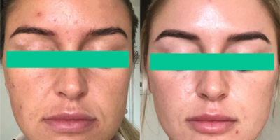 25-34 year old woman treated with Morpheus8 - Patient had a series of Morpheus8 treatments