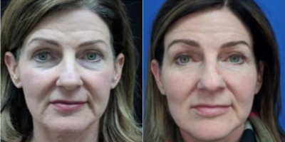 45-54 year old woman treated with Collagen Injection - Platelet rich plasma injections done for tear-troughs as a more natural approach to fillers.