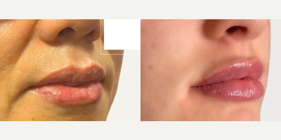 Woman treated with Lip Fillers - Woman treated with Lip Fillers