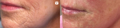 Woman treated with Dermal Fillers - Woman treated with Dermal Fillers