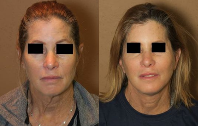 Woman treated with Cheek Lift - Woman treated with Cheek Lift