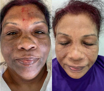 Woman treated with Mesotherapy - Woman treated with Mesotherapy