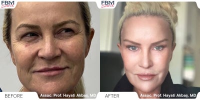 55-64 year old woman treated with Deep Plane Facelift - .
