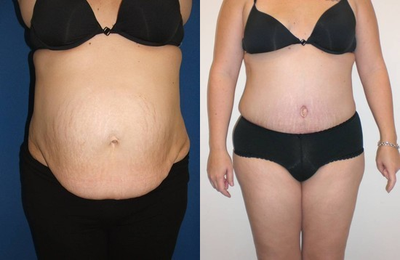 Tummy Tuck - 
	Tummy Tuck
