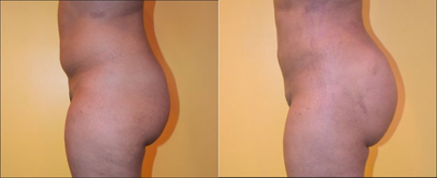 Butt Augmentation - Female shown before and after liposuction of abdomen, flanks, midback, thighs and Butt Augmentation